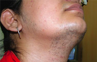 Hormonal Skin Disorders
